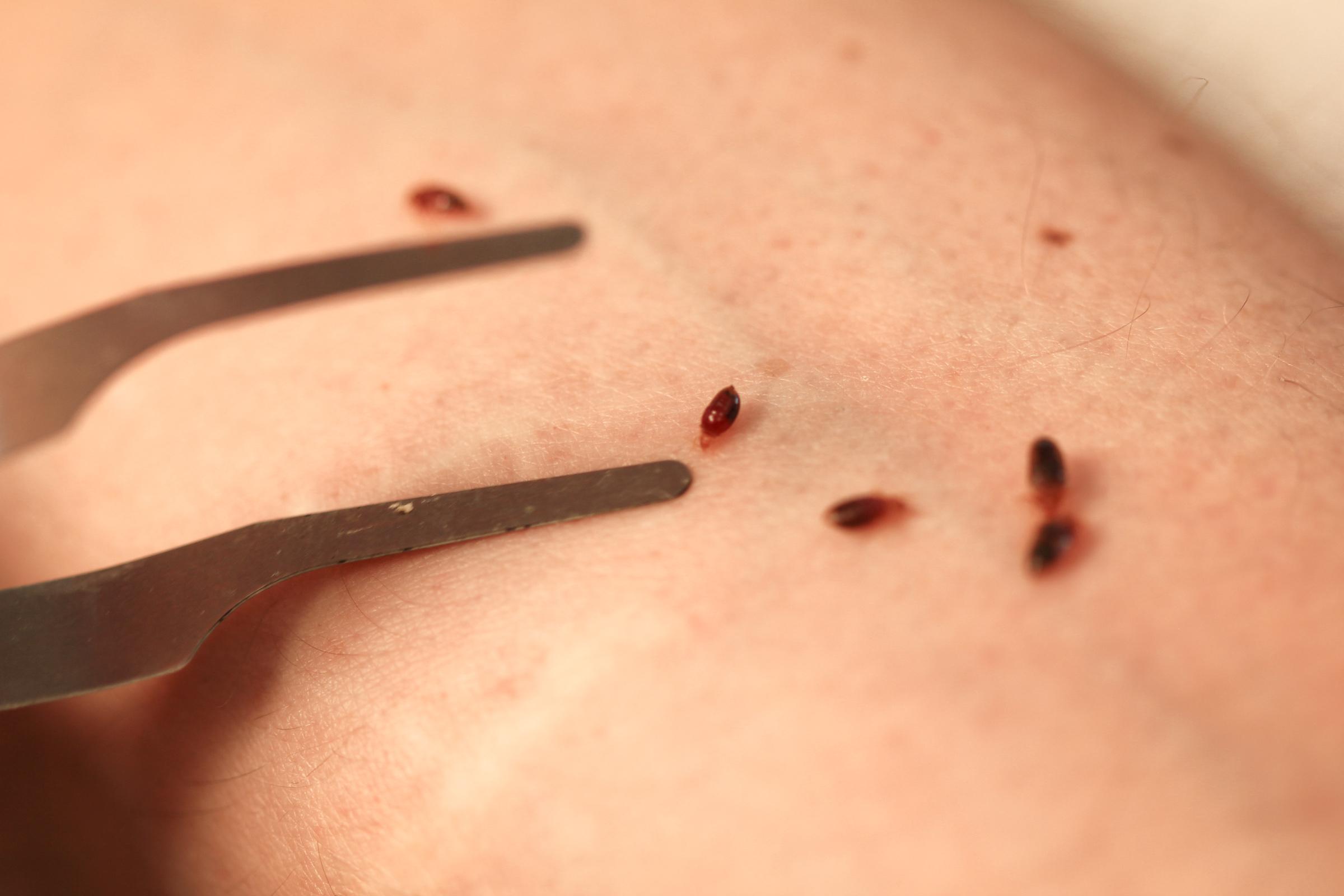 Chicago No. 1 City for Bedbugs 4 Years in a Row Chicago News WTTW